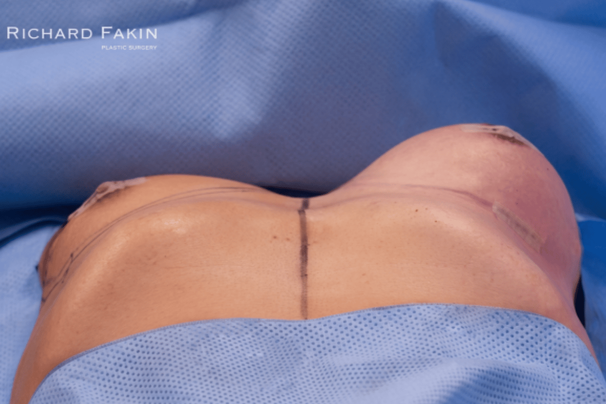 Aumento de pecho con implantes antes de la cirugía y aspecto intraoperatorio