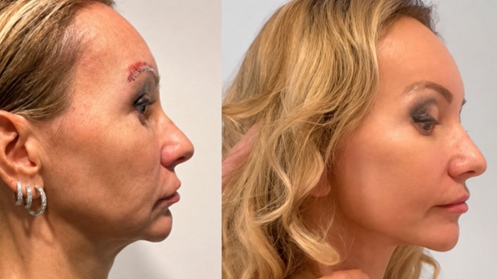 Antes y después de un lifting facial en Madrid realizado por el Dr. Richard Fakin