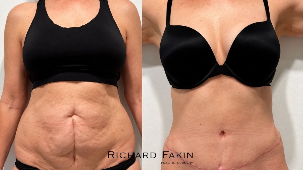 Abdominoplastia con Lipo 360 antes y después, vista frontal: abdomen con exceso de piel y pliegues antes de la cirugía y abdomen más plano con cicatriz baja después