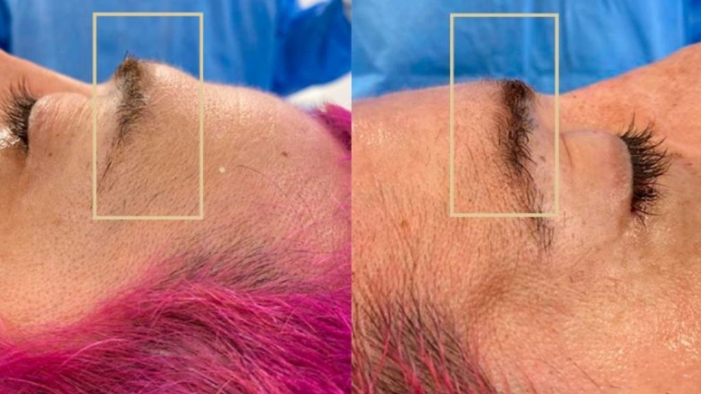 Arco superciliar antes y después del contorneado del hueso frontal realizado por el Dr. Richard Fakin, fotografiado en quirófano durante una feminización facial