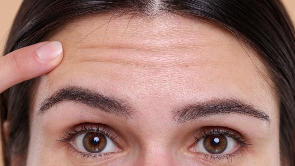 Mujer señalando su frente y la línea del cabello, zona que se modifica en una frontoplastia