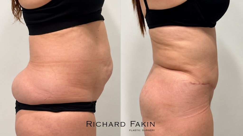Antes y después de Lipo 360 con abdominoplastia a un mes, vista lateral, Dr. Richard Fakin